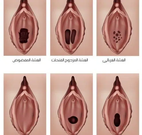 طرق فض غشاء البكارة.. وما هي أنواع غشاء البكارة