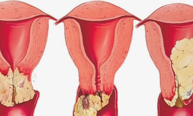 كيفية علاج فطريات المهبل للحامل