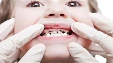 لماذا يعاني الأطفال من مشاكل تسوس الأسنان ؟
