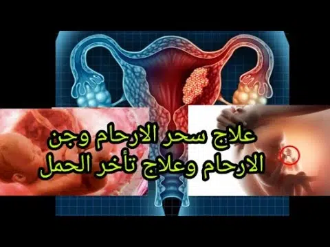 علاج سحر الأرحام مجرب