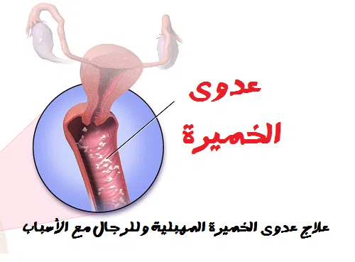 علاج عدوى الخميرة المهبلية في المنزل 