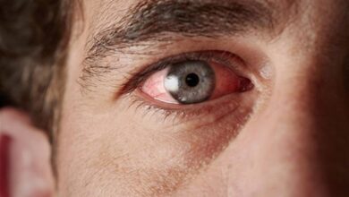 6 وصفات منزلية لعلاج حساسية العين في الربيع