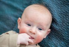 حساسية اللاكتوز عند الرضع 