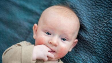 حساسية اللاكتوز عند الرضع 